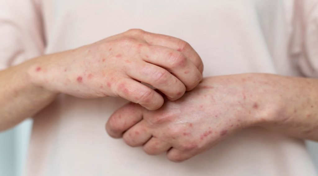 Dermatitis atópica