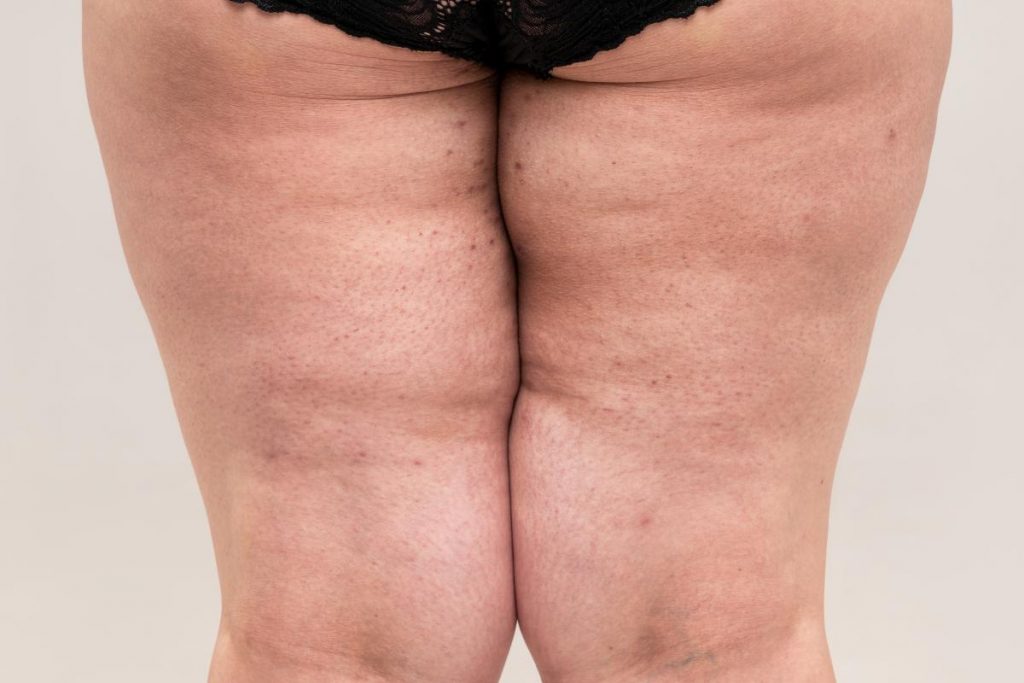 Lipedema: qué es, causas y síntomas