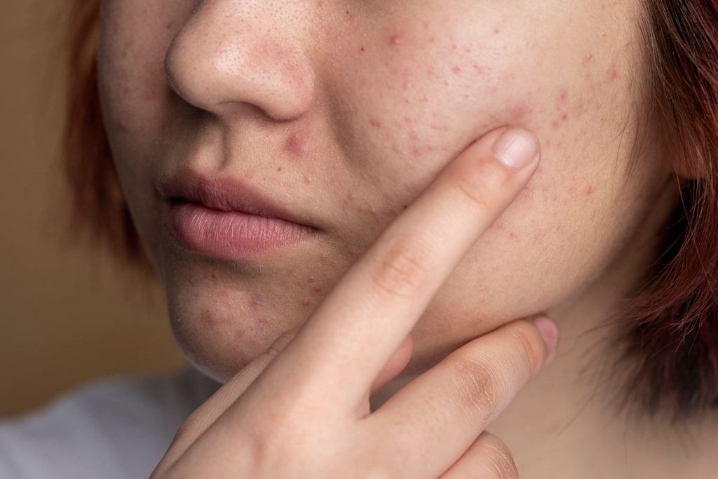 Rostro con acné por consumo excesivo de azúcar