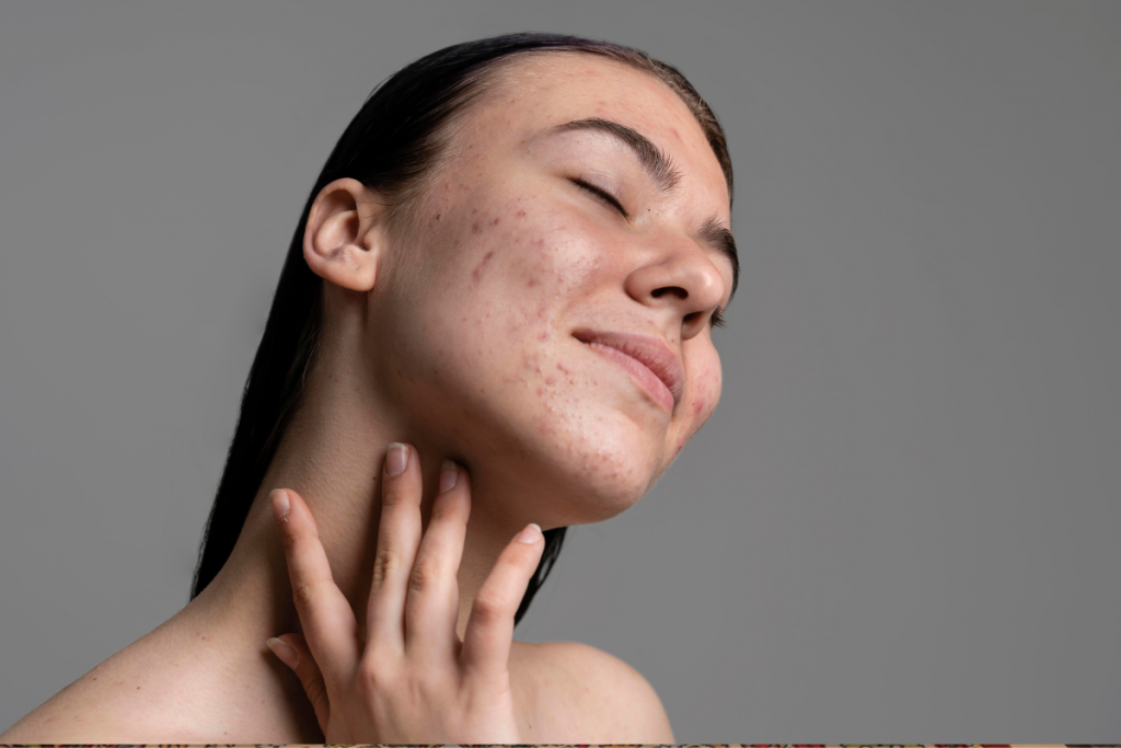 Winlevi® amplía el abordaje hormonal del acné con clascoterona 1% en crema