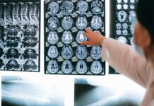 Ictus: qué hacer si ves estos síntomas en alguien (y por qué no hay que esperar) ictus